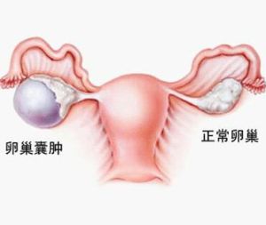 卵巢囊腫 卵巢囊腫