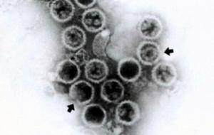 帶狀皰疹病毒性鞏膜炎