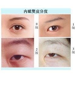 上瞼下垂矯正術 上瞼下垂矯正術