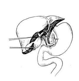 小兒囊腫 小兒囊腫