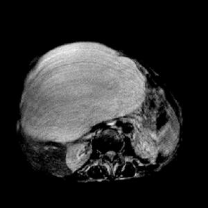 非寄生蟲性肝囊腫