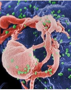 愛滋病性頸淋巴結腫大 愛滋病性頸淋巴結腫大