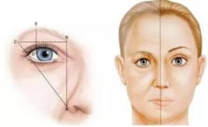 埋線祛皺 埋線祛皺