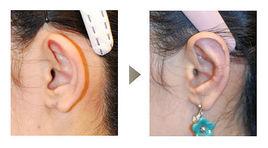 附耳切除術 附耳切除術