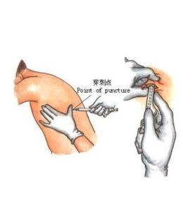 胸膜腔穿刺術 胸膜腔穿刺術