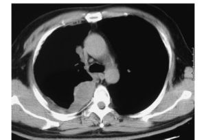 瀰漫性胸膜間皮瘤 瀰漫性胸膜間皮瘤