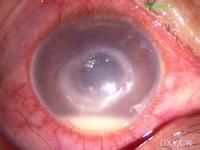 角膜基質炎 角膜基質炎