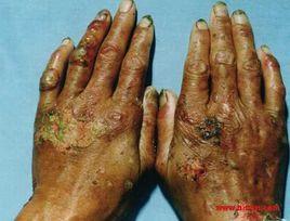 土耳其卟啉病 土耳其卟啉病