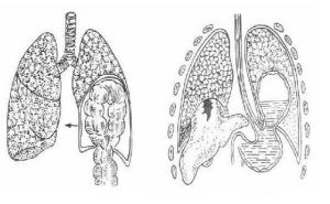 膈肌破裂 膈肌破裂