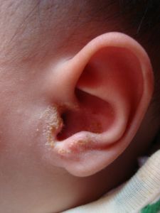 兒童中耳炎