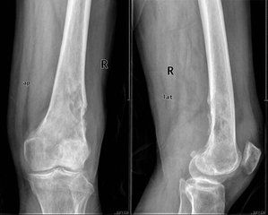 骨惡性纖維組織細胞瘤 骨惡性纖維組織細胞瘤
