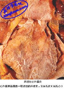 急性血源性骨髓炎