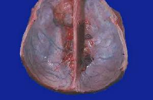 多發性腦膜瘤
