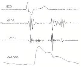 舒張早期奔馬律 舒張早期奔馬律