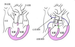 矯正型大動脈轉位