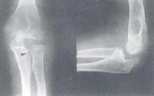 褐黃病性關節炎