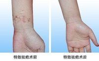 除疤手術 除疤手術