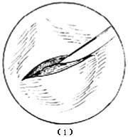 外陰脂肪瘤 外陰脂肪瘤