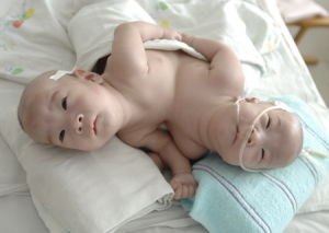 連體嬰兒