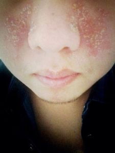 面部脂溢性皮炎症 面部脂溢性皮炎症