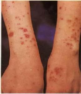 成人斯蒂爾病 成人斯蒂爾病