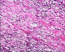 甲狀腺左葉結節 甲狀腺左葉結節