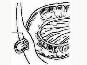 小兒疝氣 小兒疝氣