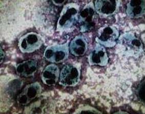 復發性無菌性腦膜炎