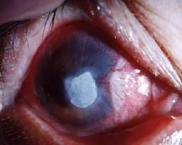 慢性角膜炎 慢性角膜炎