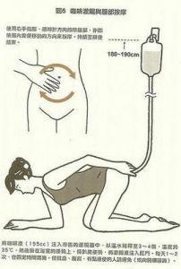 清潔灌腸 清潔灌腸