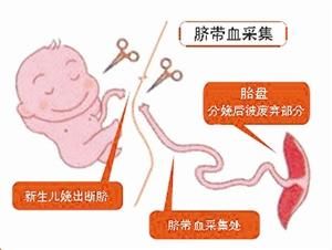 臍帶血穿刺 臍帶血穿刺