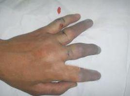 血運障礙 血運障礙