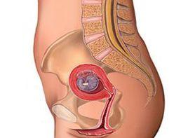 產後惡露不淨有臭味 產後惡露不淨有臭味