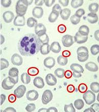 過敏反應血小板減少