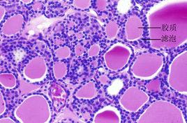 甲狀腺濾泡腔 甲狀腺濾泡腔