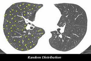 急性肺源性心臟病