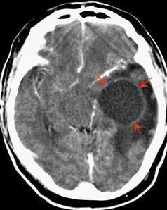 惡性腦膜瘤 惡性腦膜瘤
