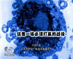 非典型性肺炎非典