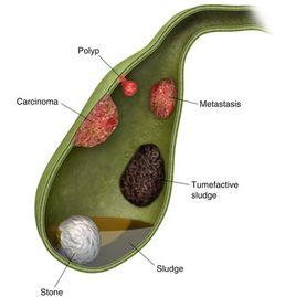 膽管息肉 膽管息肉