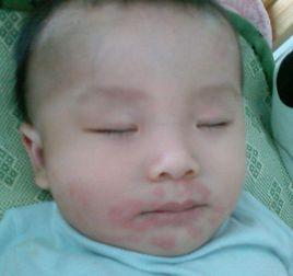 過敏奶粉 過敏奶粉