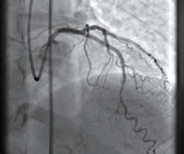 三支病變 三支病變