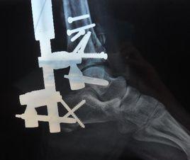 關節內骨折康復 關節內骨折康復