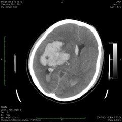 腦內出血 腦內出血