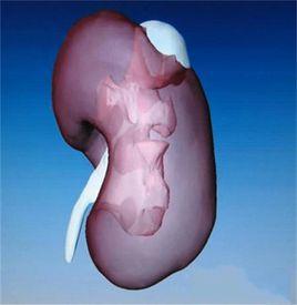 腎臟囊腫 腎臟囊腫