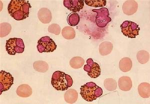 遺傳性口形紅細胞增多症