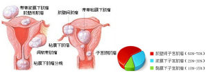 子宮肌瘤症狀