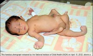 六腿嬰兒 六腿嬰兒