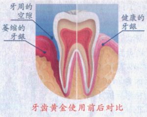 牙齦萎縮 