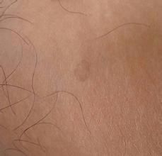 花斑糠疹 花斑糠疹