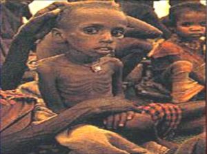 蛋白質—能量營養不良症